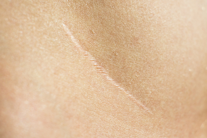Close up of scar on skin