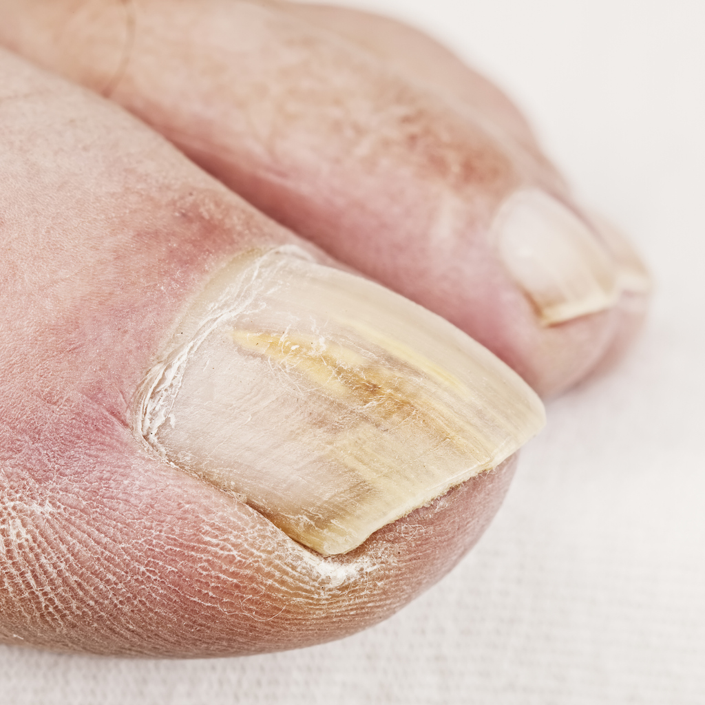 fungal-toenail-infection