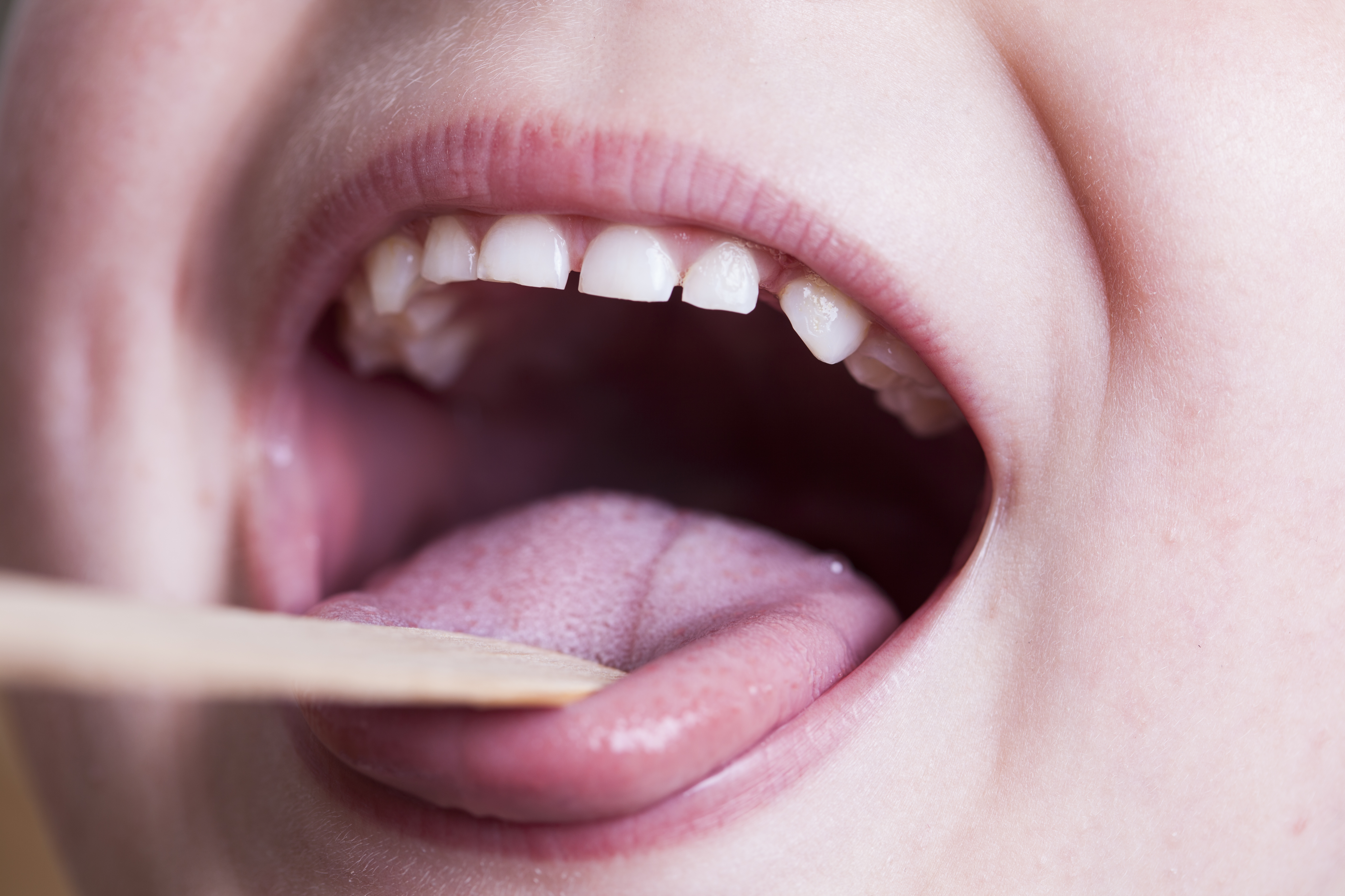 Throat Infections stock photo
